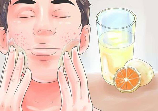 Sivilce Limon Kullanımı ve Faydaları Nelerdir?